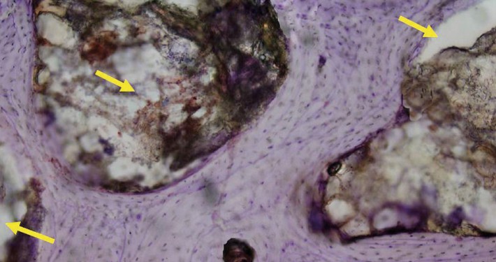 CERASORB-Foam-Dental