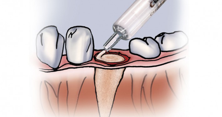 CERASORB-Paste-Dental